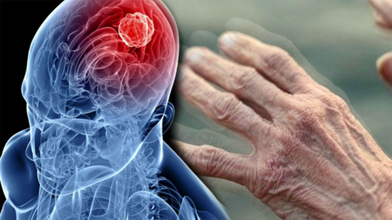 Alimlərdən tarixi kəşf: Parkinson artıq bu üsulla erkən aşkarlana bilər