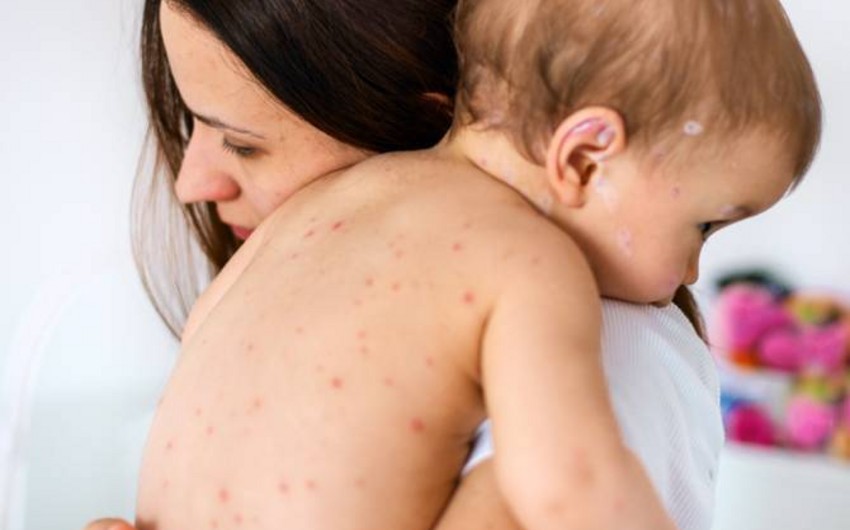Number of confirmed measles cases in Armenia reaches 513