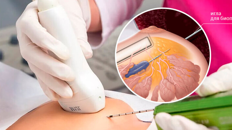 Biopsiyanı əvəz edəcək yeni üsul tapıldı